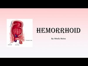 Hemorrhoid - classification, risk factor, investigation, treatment, complication