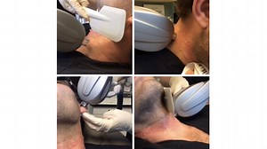 Laser Hair Removal for Men: Ears, Neck, and Beard
