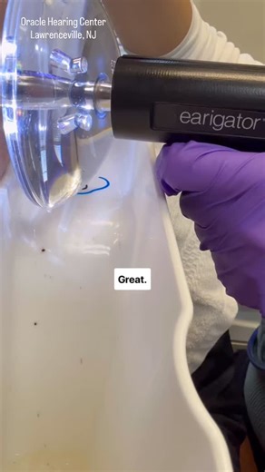 Yasmin Battat, AuD on Instagram: "He told us his left ear was blocked and that he had tried to get the wax out with with drops but had no success. It’s no wonder. There were layers and layers of wax. So glad we could help him hear again. Like and follow for more ear shenanigans. Www.oraclehearingcenter.com #oraclehearingcenter #lawrencevillenj #earwaxremoval #earwaxextraction #earigator #hearingloss #audiologist #earwax #ears #drpimplepopper #hearingloss #satisfyingvideos #satisfying #qtips #ear