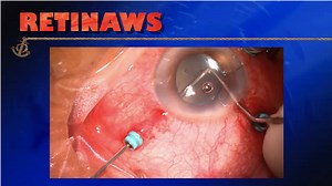 Choroidal Detachment - Eyetube
