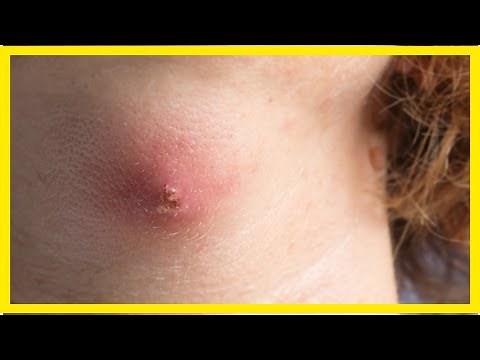 Abszess – Ursachen und Behandlung