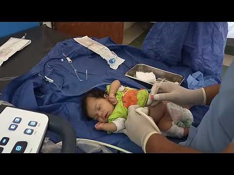 Pediatric peritoneal dialysis