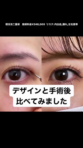手術前のシュミレーションと実際の手術後を比べてみました💡#二重整形 #埋没法 #ミックス二重