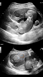 Coming Soon !!!💯🎉❤️💜💜💞💋💃 #childbirthtelevision #scan #birthroom #muscle #pregnant #pregnancy #babyontheway #infant #baby #fetus #embryo #laboranddelivery #homebirth #birthcenter #waterbirth #hospital #epidural #pitocin #induction #naturalbirth #unmedicatedbirth #ttc #birth #childbirth #thirdtrimester #mother #father #family #BabyOnBoard #MomLife | Childbirth Television