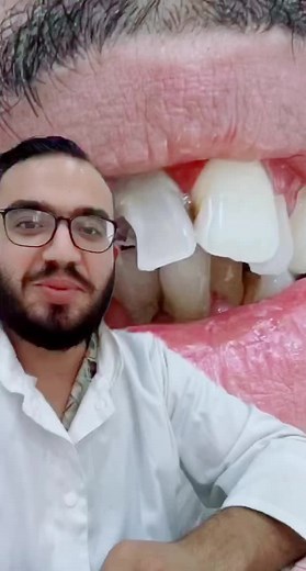 #dentist #hollywoodsmil #carie #ceramics #ziron #dent #odf