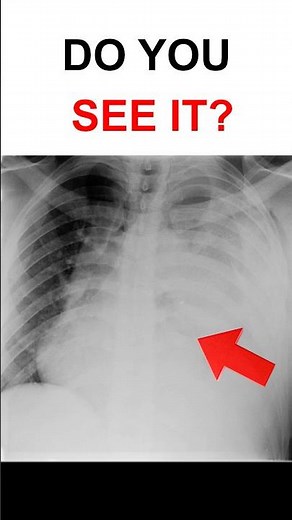 Don’t Miss This on a Chest X-ray | OSCE