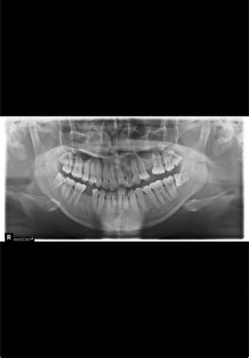 Yung gusto mo lang maging maganda ngipin pero meron ka palang mesiodens at odontomas 😜 #teethtok #braces #orthodontics #fyppppppppppppppppppppppp #fypシ #cupid