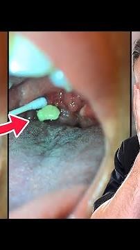 How You Are Removing Tonsil Stones The WRONG Way!