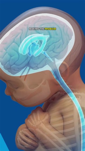 Hydrocephalus Surgery 3D Animation #hydrocephalus #hydrocephalusawareness #ventriculostomy #brainsurgery #csf