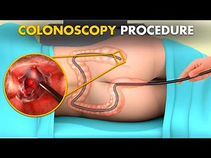 Colonoscopy procedure | Colon Biopsy | 3D animation