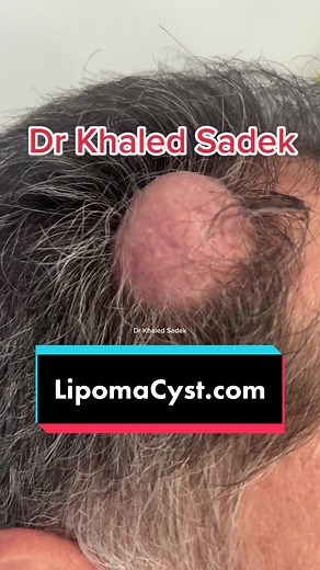 Pilar Cyst Removal by Dr. Khaled Sadek | Skincare Procedure