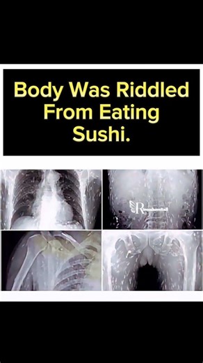 ℝ𝕚𝕤𝕖𝕤𝕒𝕓𝕠𝕧𝕖𝕚𝕥𝕒𝕝𝕝- Functional + Holistic Medicine on Instagram: "Did you know your body can host unwanted guests for years… even decades without obvious symptoms? We tend to focus on lice, ticks, or mites, but the real troublemakers live inside the body. 🪱 Tapeworms can grow up to 30 feet long, attach to the intestinal wall, steal nutrients, lay eggs, and quietly linger for decades. 🦠 Flukes can hide in the liver, lungs, brain, and nervous system, forming cysts and triggering sympt