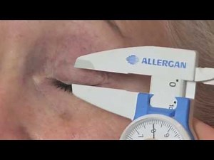 moderne und sichere Lid OP bei Schlupflid | Köln • Hamburg • Berlin