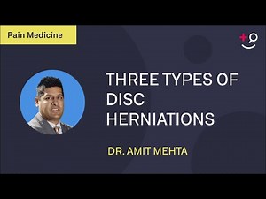 What are the three most common types of disc herniations?