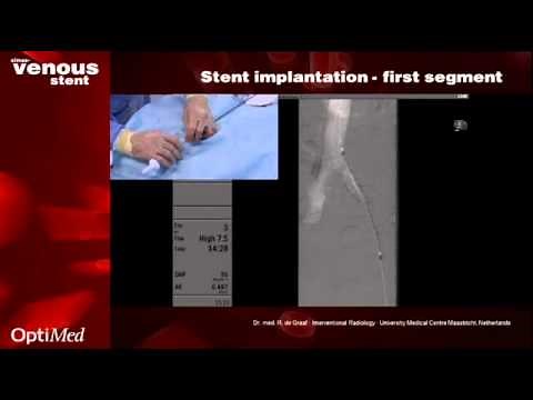 sinus-Venous stent in practice