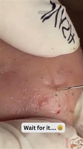 Deep Blackheads, Milia & Whitehead Removal pimple popping New| Big Cystic Acne Extraction #1146 2026