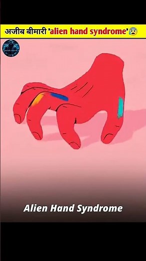 alien hand syndrome #facts #shorts