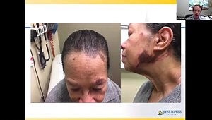 Diagnosis and Treatment of Idiopathic Inflammatory Myositis: What Are The Best Practices For Diagnosis? Which New Drug Trials to Watch Out For?