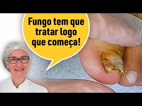 NAIL FUNGUS: TREAT IT AS SOON AS POSSIBLE TO AVOID IT GETTING LIKE THIS