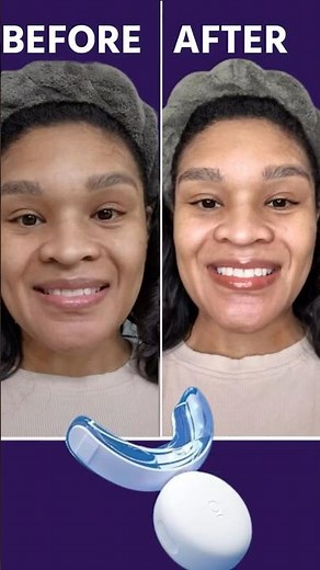 How to Use a Teeth Whitening Kit at Home