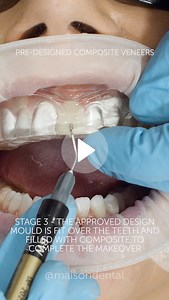 Pre-Designed Composite Veneers - Maison Dental