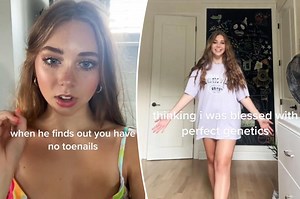I was born without toenails — now I’m an online sensation