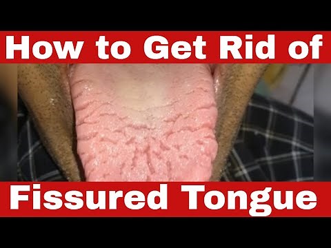 How to Get Rid of Fissured Tongue? The Truth!