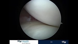 Repair of a Ramp Lesion Bucket Handle Tear