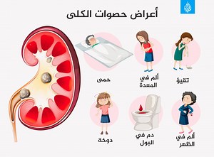 حصوات الكلى.. كل ما تريد معرفته عن أنواعها وأعراضها وطرق علاجها