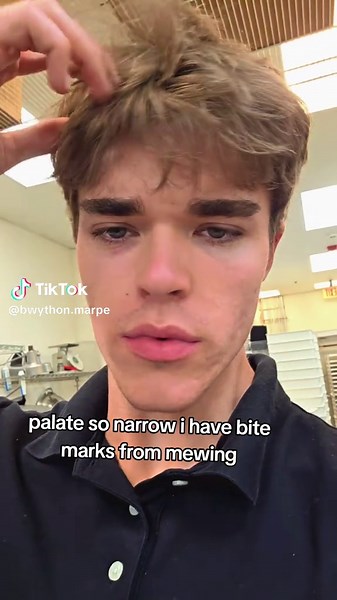 Expanding a Narrow Palate with Marpe Techniques