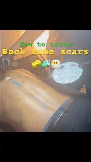 How to treat: Back Acne Scars