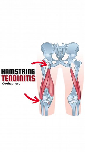 How to strengthen the hamstring tendon for tendinitis #physiotok #torontophysio #hamstrings