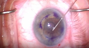 DMEK in Fuchs Endothelial Dystrophy - Eyetube
