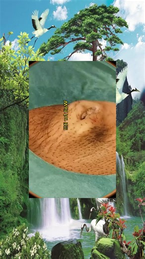 #acne #pimple #pimples #pimplepop #satisfyingvideo #pimplepopper #fyp