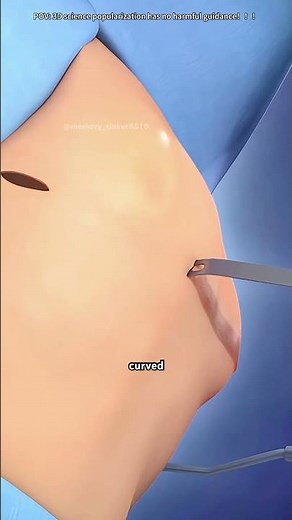 Pectus Excavatum And Nuss Procedure (3D Animation)#pectusexcavatum? #pectusexvactum