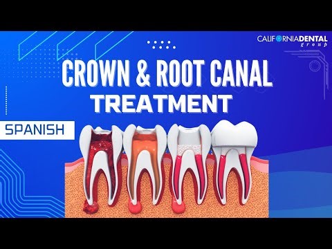 Crown and Root Canal Treatment - Spanish