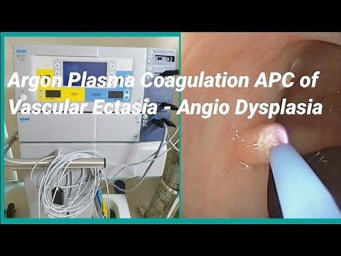 Angio Dysplasia or Vascular Ectasia Argon Plasma Coagulation APC - SQUARE HOSPITAL LTD #BD_ENDOSCOPY