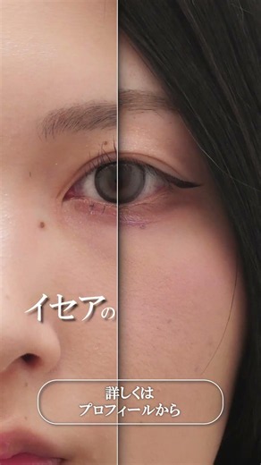 二重全切開法の症例です。まぶたの厚みやラインの癖に合わせて、自然な二重をデザインしています。埋没で安定しなかった方や、長期的に二重を維持したい方に選ばれる施術です。
