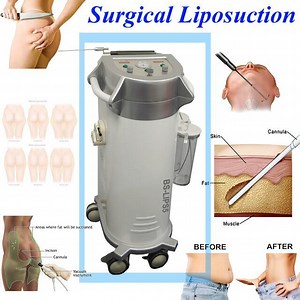 [Hot Item] Liposuction Cannulas Surgery Ultrasonic Liposuction Equipment Price Surgical Liposuction Machine