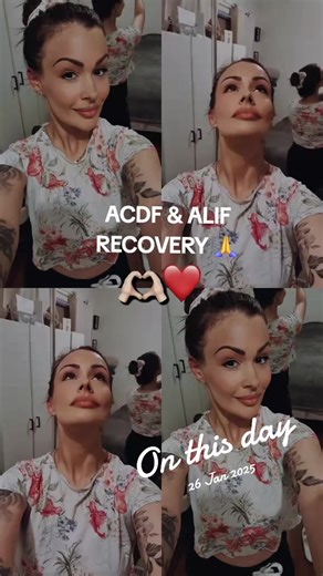 January 2025 reflection ALIF & ACDF surgery from 2024. Rehab everyday is a MUST for the back and neck. No surgery is a quick fix.🙌 #jdmyjourney #domesticviolancesurvivor #traumahealing #gratitude #fyp