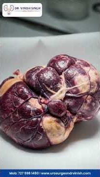 😱 What is Epididymo-orchitis? | Correct treatment for testicular pain and swelling ⚕️ | Dr. Vinis...