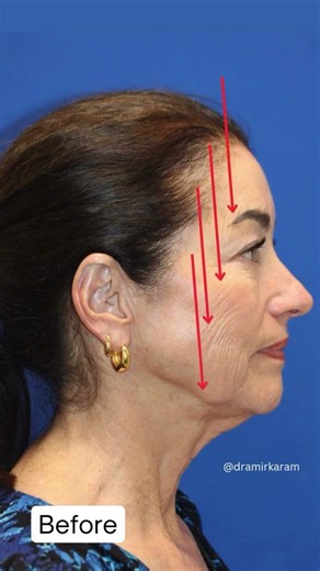 Neck and jawline completely lifted! 5 month update Vertical Restore facelift