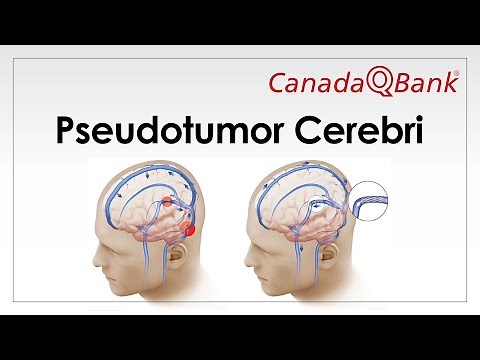 Pseudotumor Cerebri (Idiopathic Intracranial Hypertension) Causes, Symptoms & Management | Neurology
