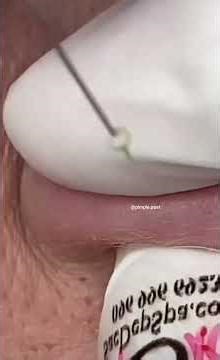 Deep Cyst Explodes! 😳 | Skincare Extraction Compilation #Shorts