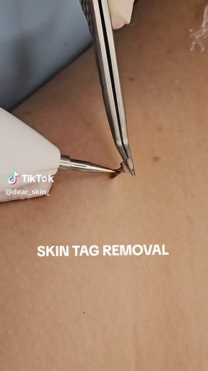 Learn Effective Skin Tag Removal Methods | Get Rid of Unwanted Skin Tags