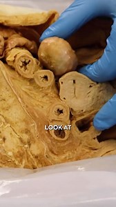 1.7M views · 1.7K reactions | Huge Abnormal Ovary! #ovary #pcos #pain #reproduction | Institute of Human Anatomy | Facebook