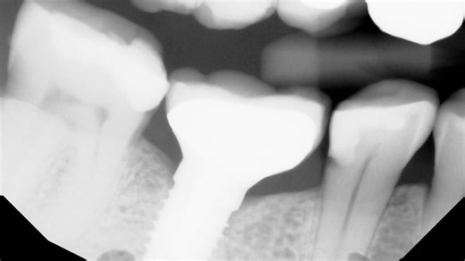 Dentists warn of removing fluoride in NY water. But many upstate counties already don't have it