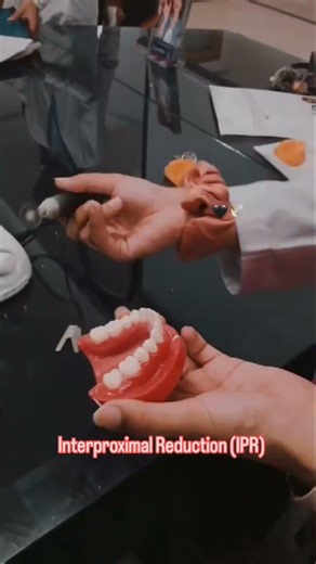 Interproximal Reduction IPR 😮😷🦷🩺#bds#dentist #dentalprosthesis #dentaltreatment #orthodontics#motor