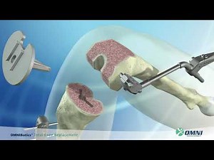 Dr. Mark Spivey: Total Knee Replacement