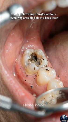 How to Repair a Visible Hole in a Back Tooth | Step-by-step Visual Explaination